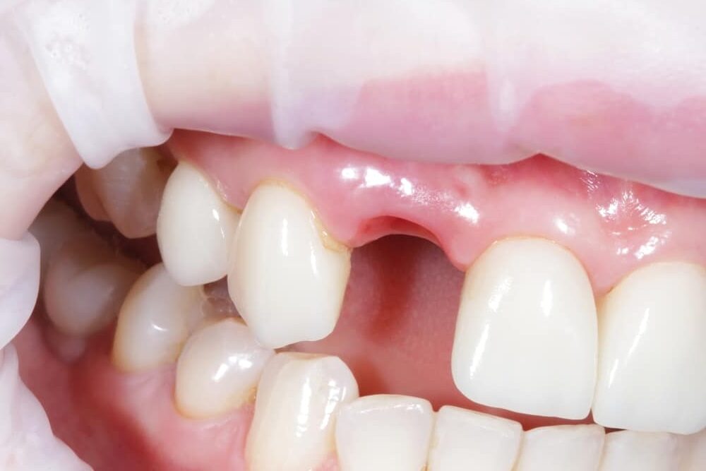 Woman,Showing,Mouth,Without,Broken,Tooth.,Gap,Toothed.,High,Quality