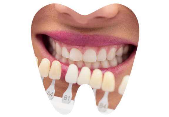 Dental Veneers