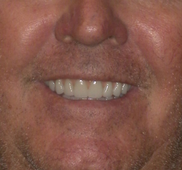 After Image: Implant Dentures - front