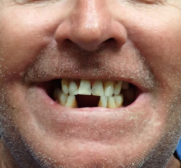 Before Image: Implant Dentures - front