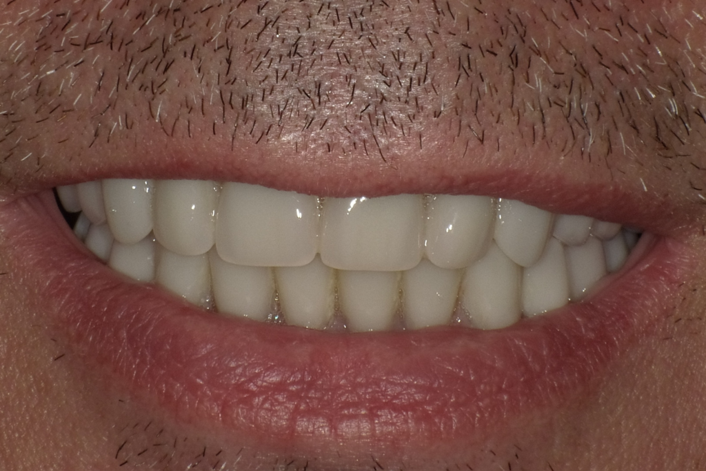 After Image: Implant Dentures - front