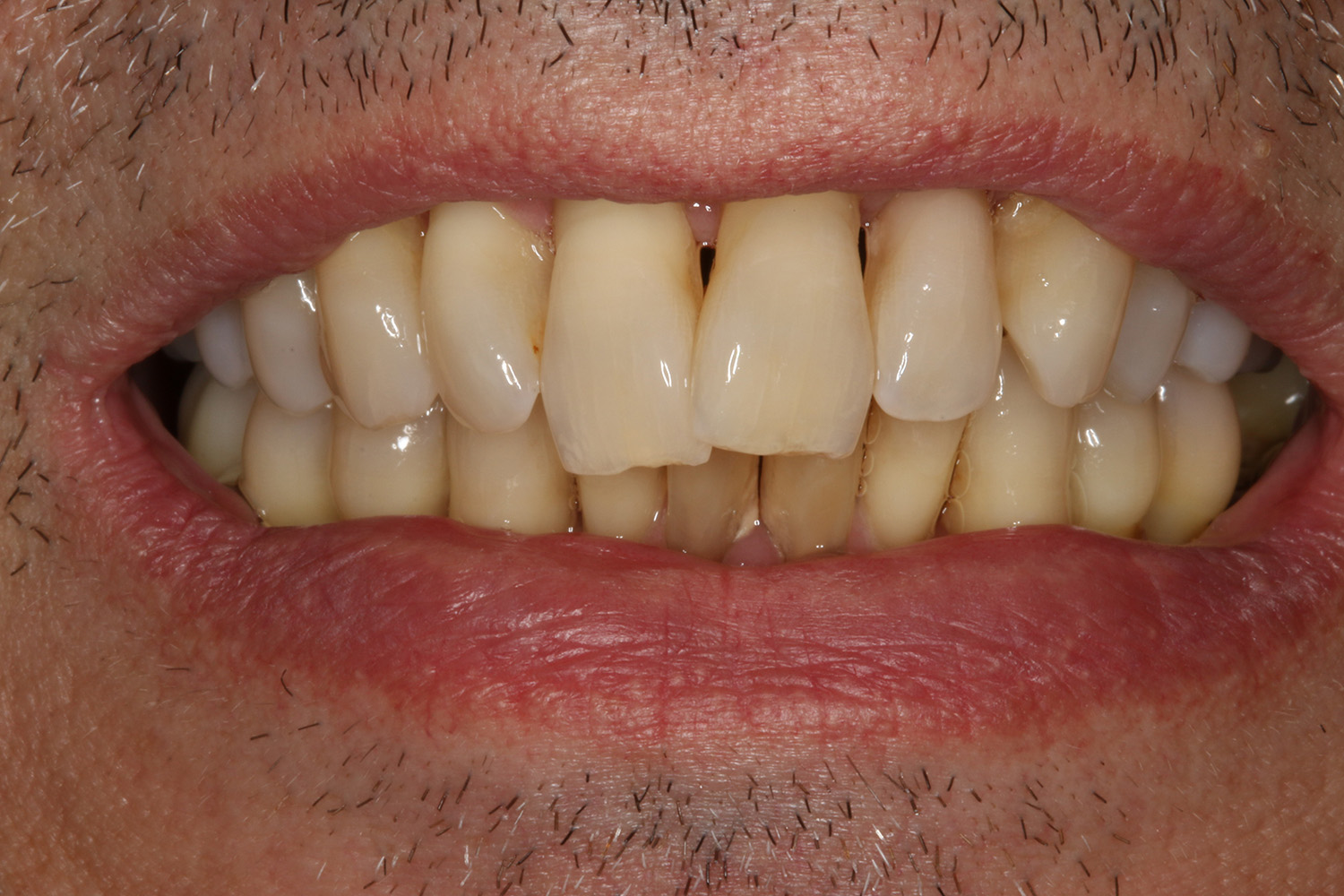 Before Image: Implant Dentures - front