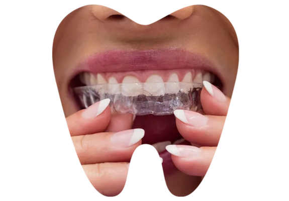 Invisalign
