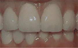 After Image: Porcelain Crowns (Caps) - front