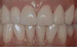 After Image: Porcelain Crowns (Caps) - front