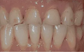 Before Image: Porcelain Crowns (Caps) - front
