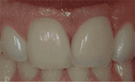 After Image: Porcelain Crowns (Caps) - front