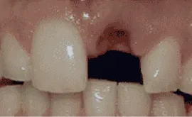 Before Image: Porcelain Crowns (Caps) - front