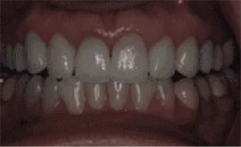 After Image: Porcelain Crowns (Caps) - front