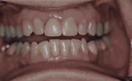 Before Image: Porcelain Crowns (Caps) - front
