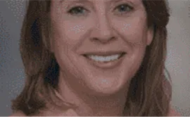 After Image: Porcelain Crowns (Caps) - front