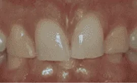 Before Image: Porcelain Crowns (Caps) - front