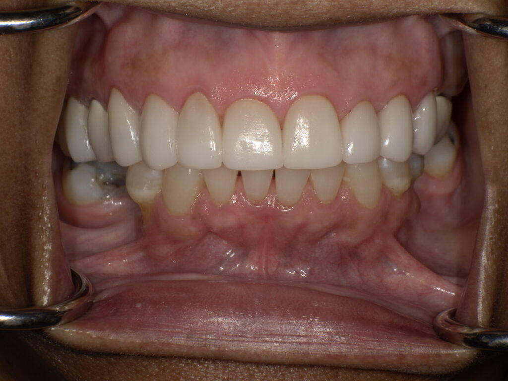 After Image: Veneers - front