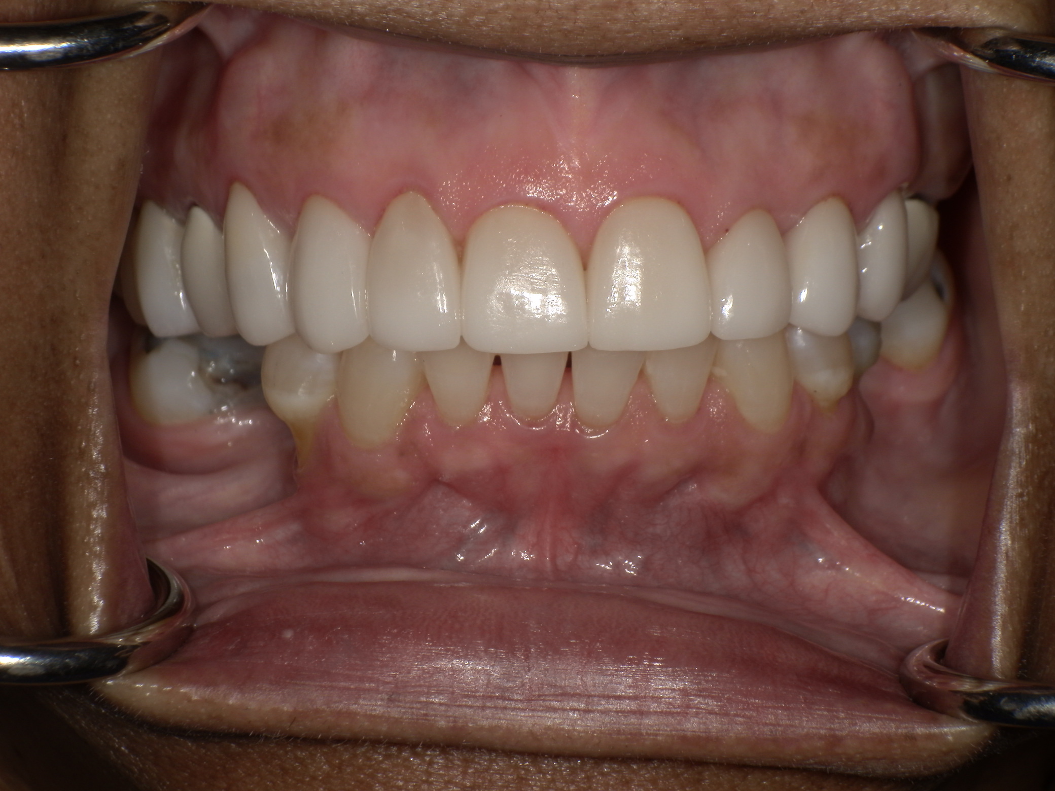 After Image: Veneers - front