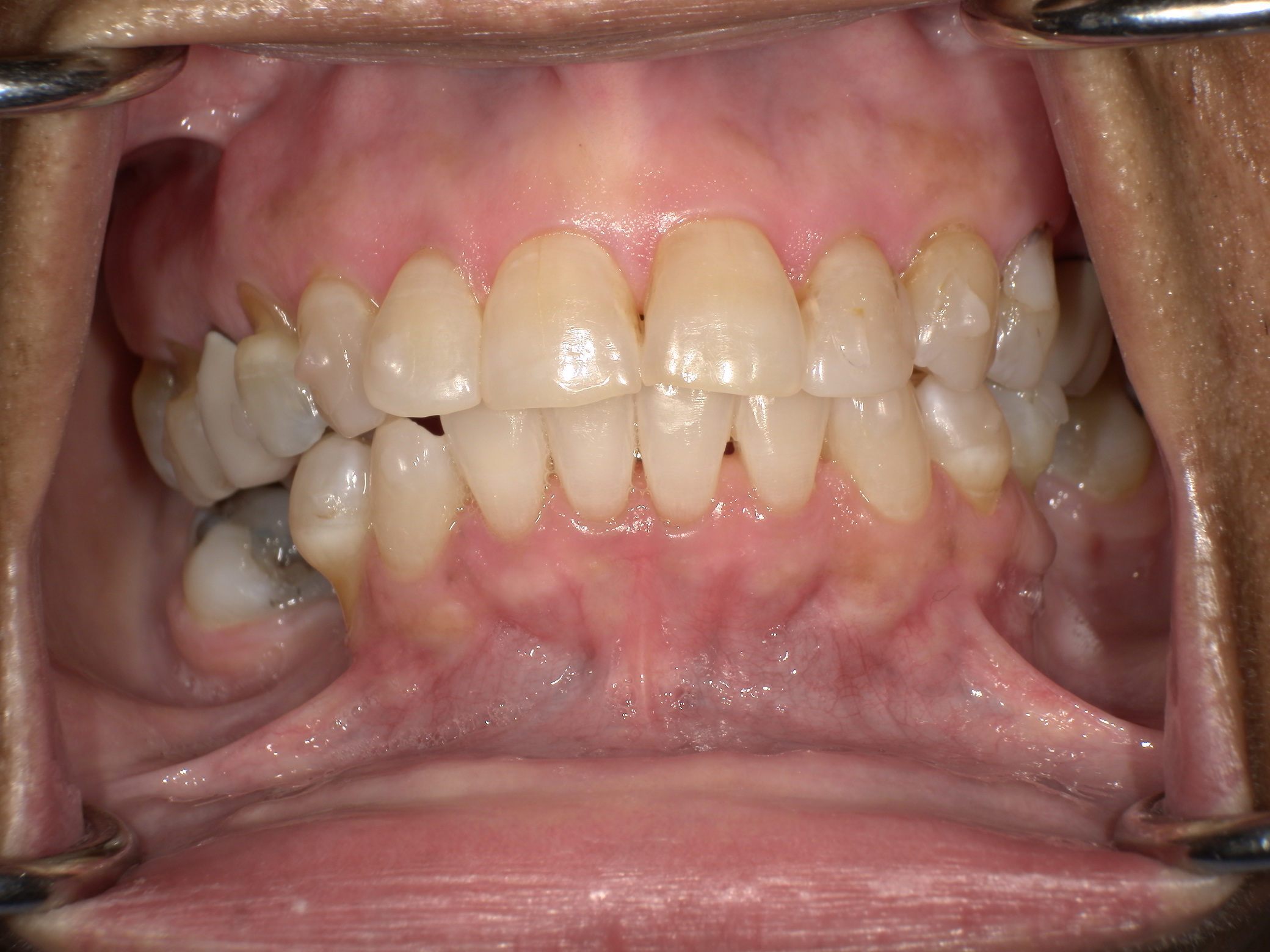 Before Image: Veneers - front
