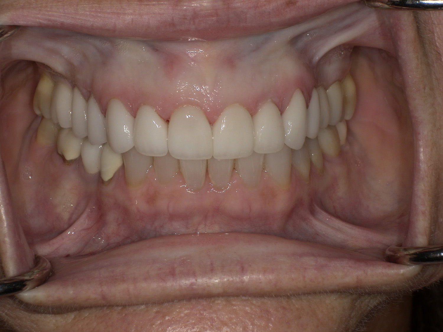 After Image: Veneers - front