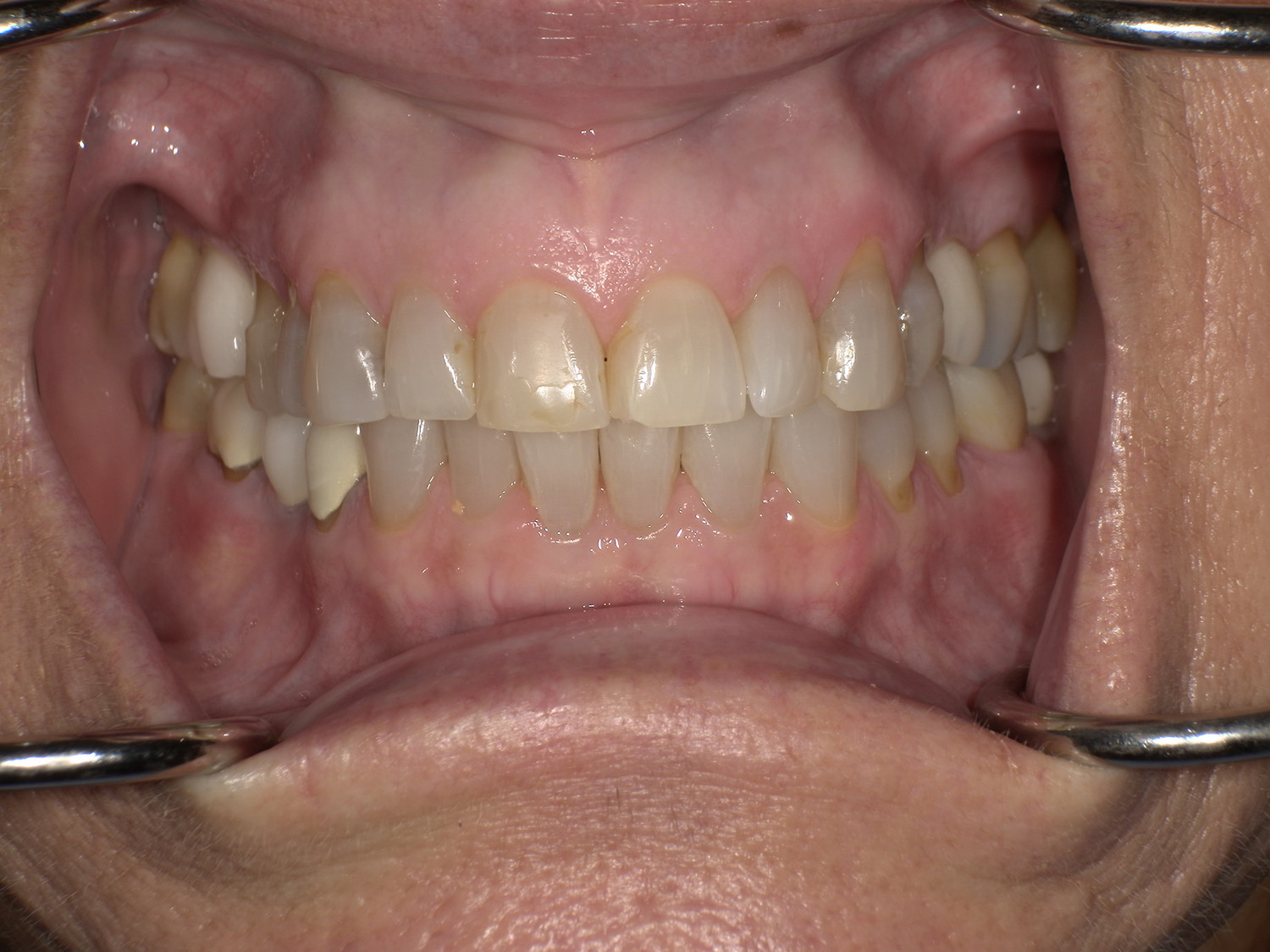 Before Image: Veneers - front