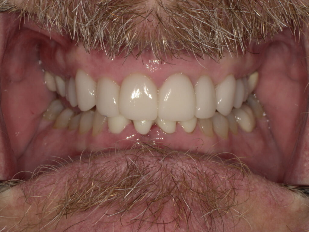After Image: Veneers - front