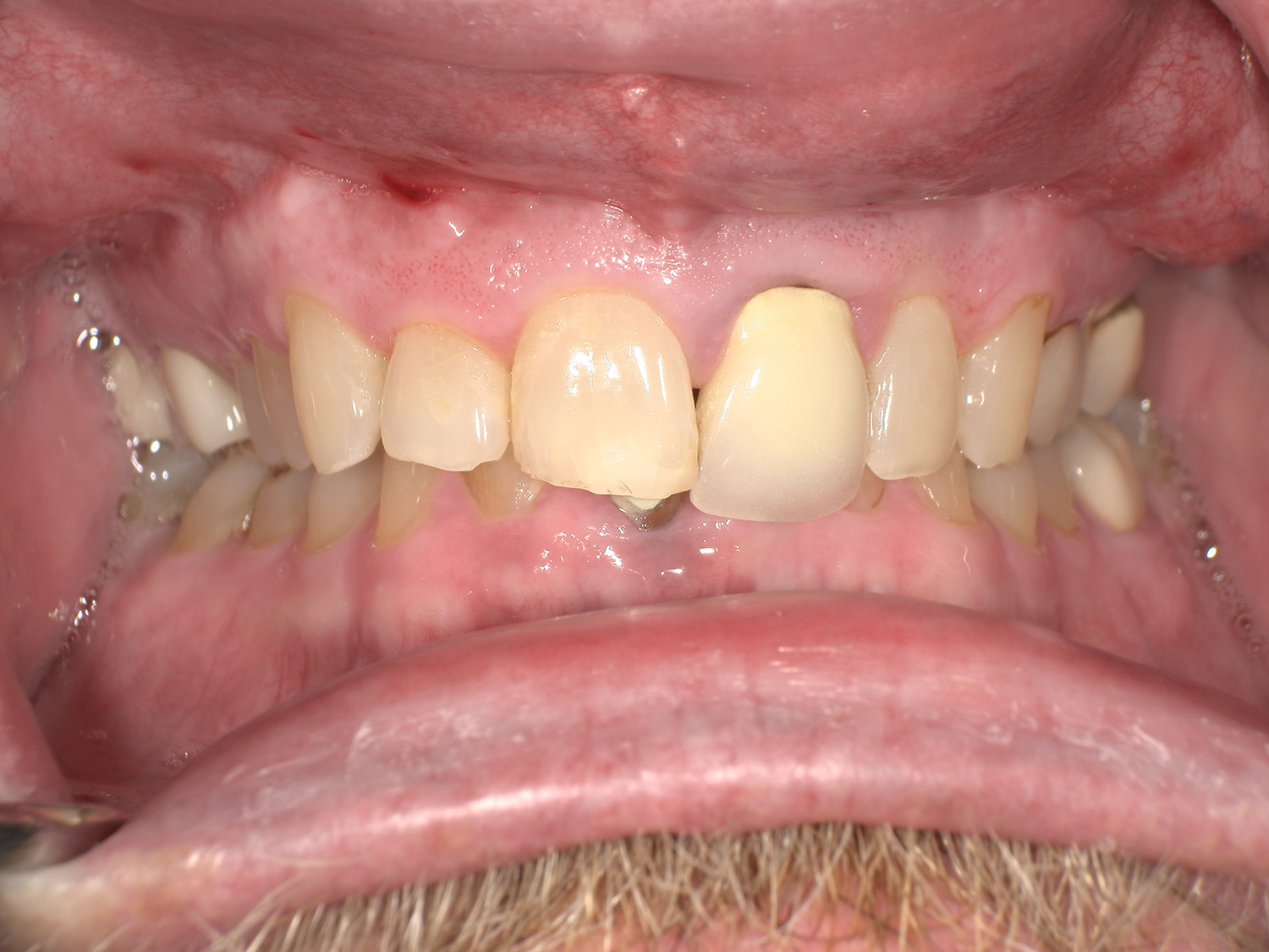Before Image: Veneers - front