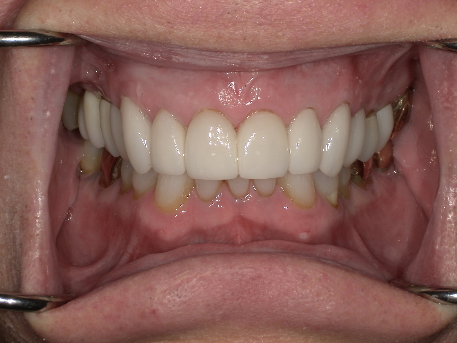After Image: Veneers - front