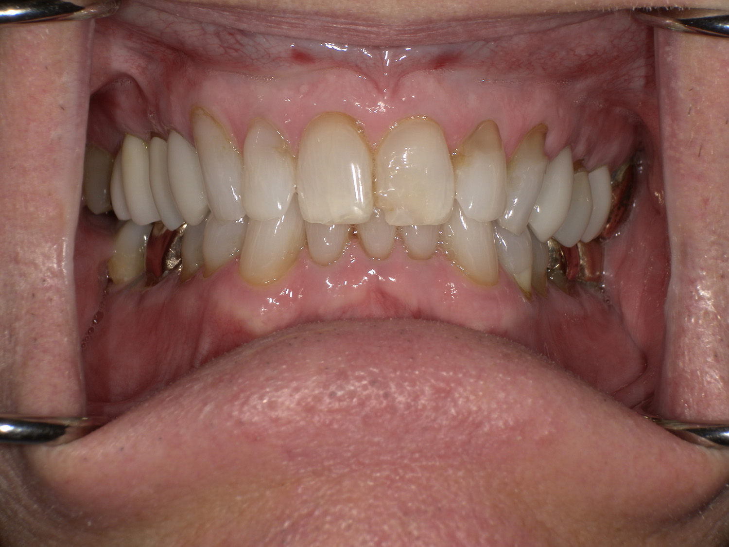 Before Image: Veneers - front
