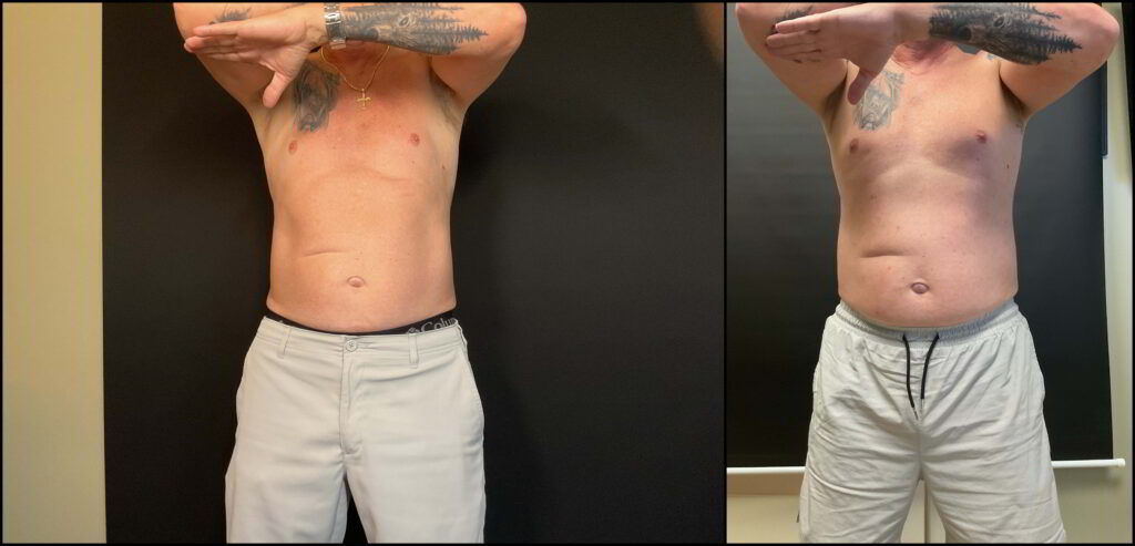 Before and After Image: Emsculpt NEO® Abdomen - front
