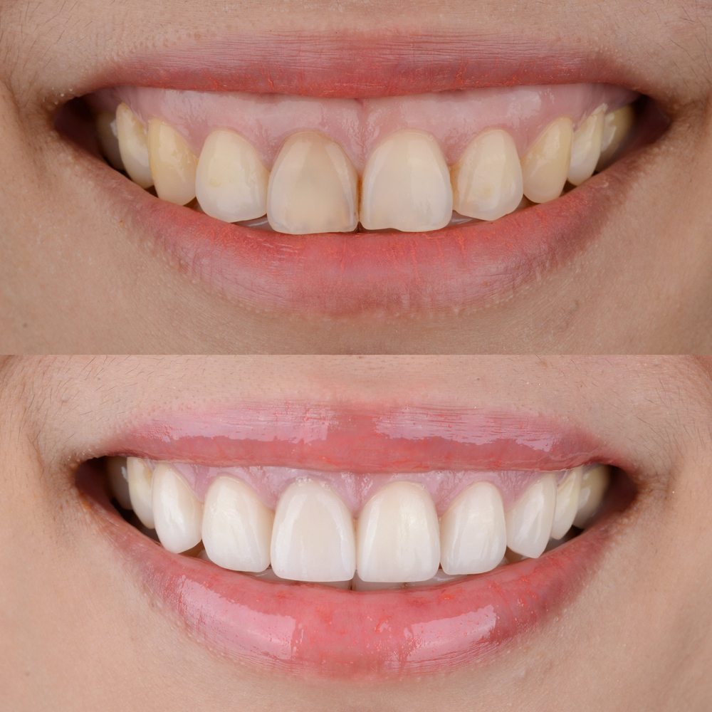 Smile makeover before and after cosmetic dental treatment.