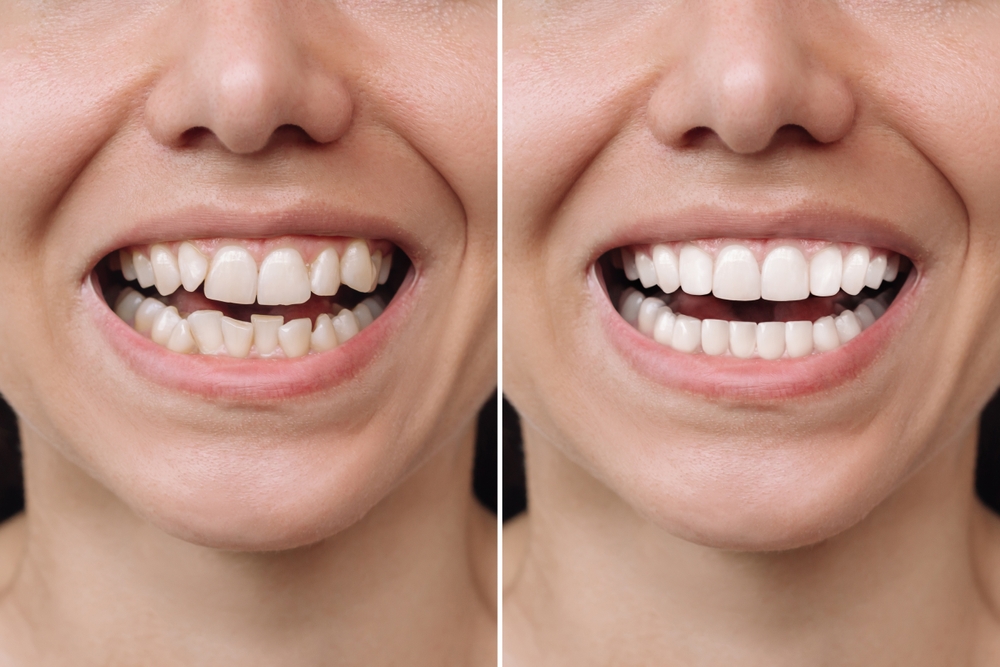Woman smiling with healthy teeth after dental implants