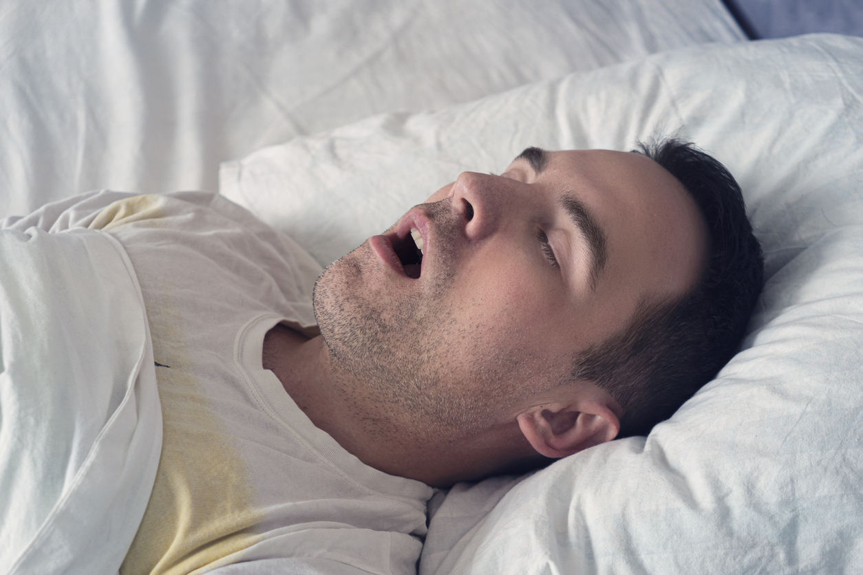 Man sleeping with his mouth open due to sleep apnea and nighttime teeth grinding.